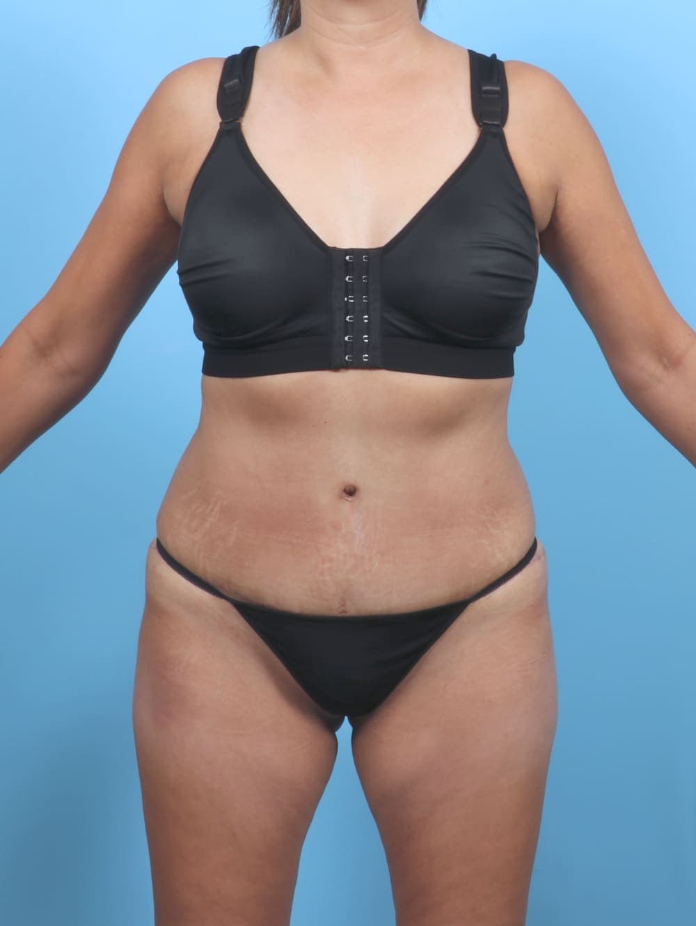 Tummy Tuck case #5839 after, image 1