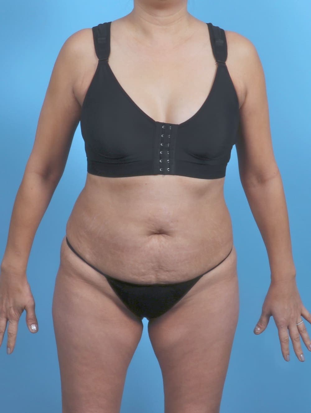 Tummy Tuck case #5839 before, image 1