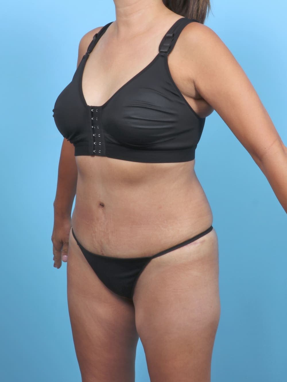 Tummy Tuck case #5839 after, image 2