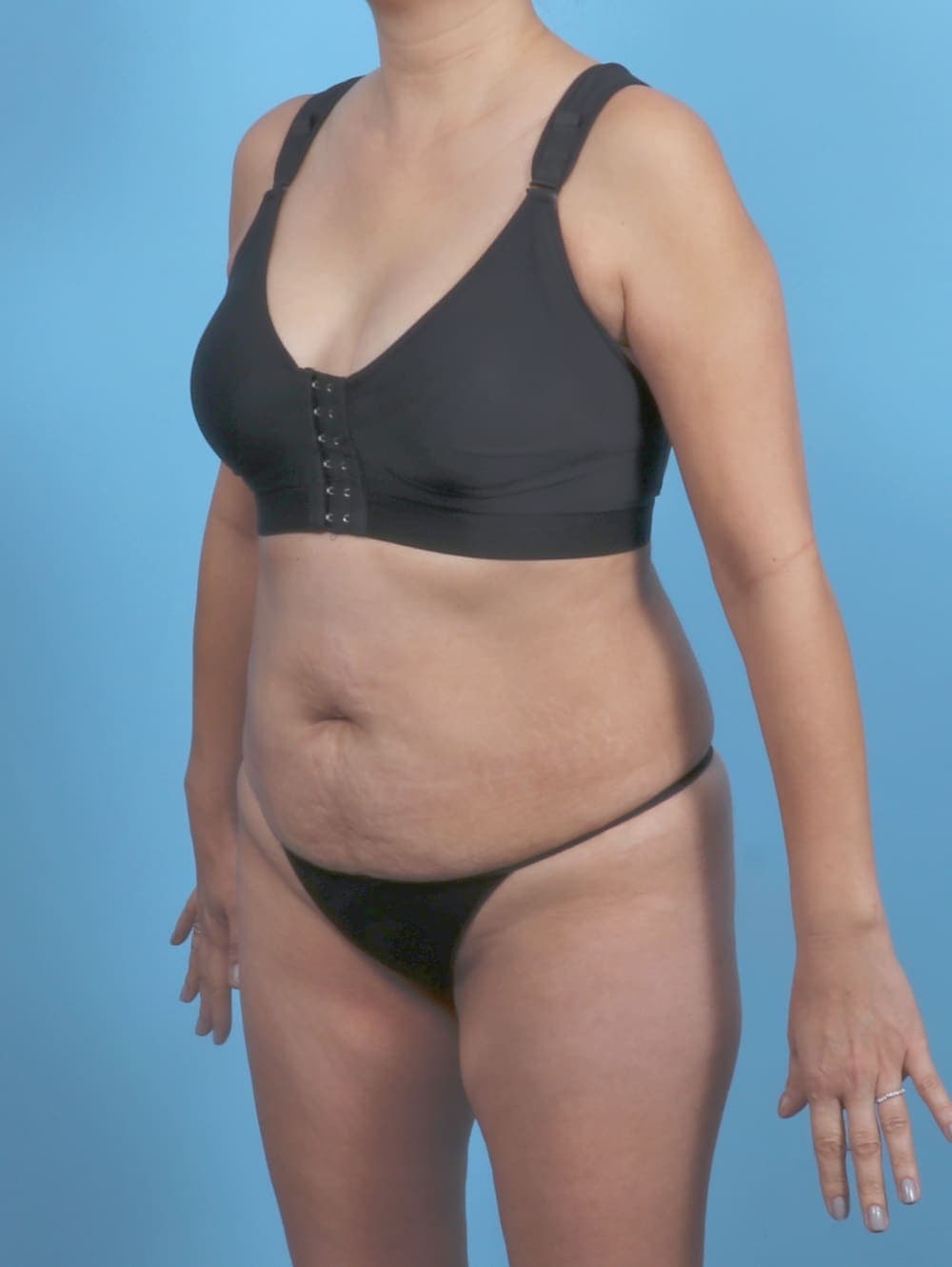 Tummy Tuck case #5839 before, image 2