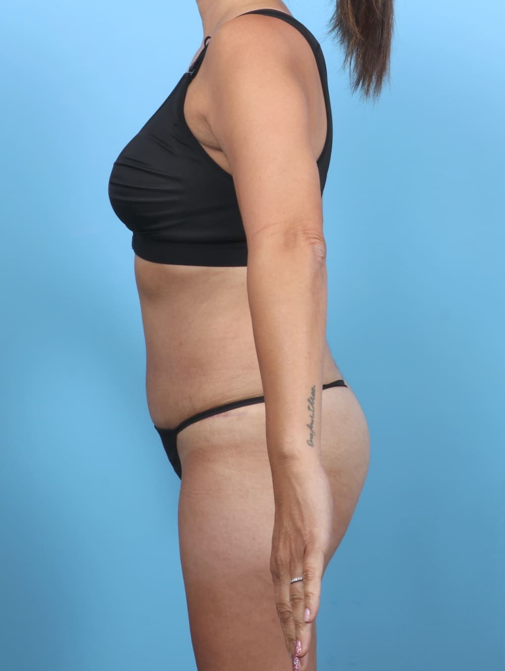 Tummy Tuck case #5839 after, image 3