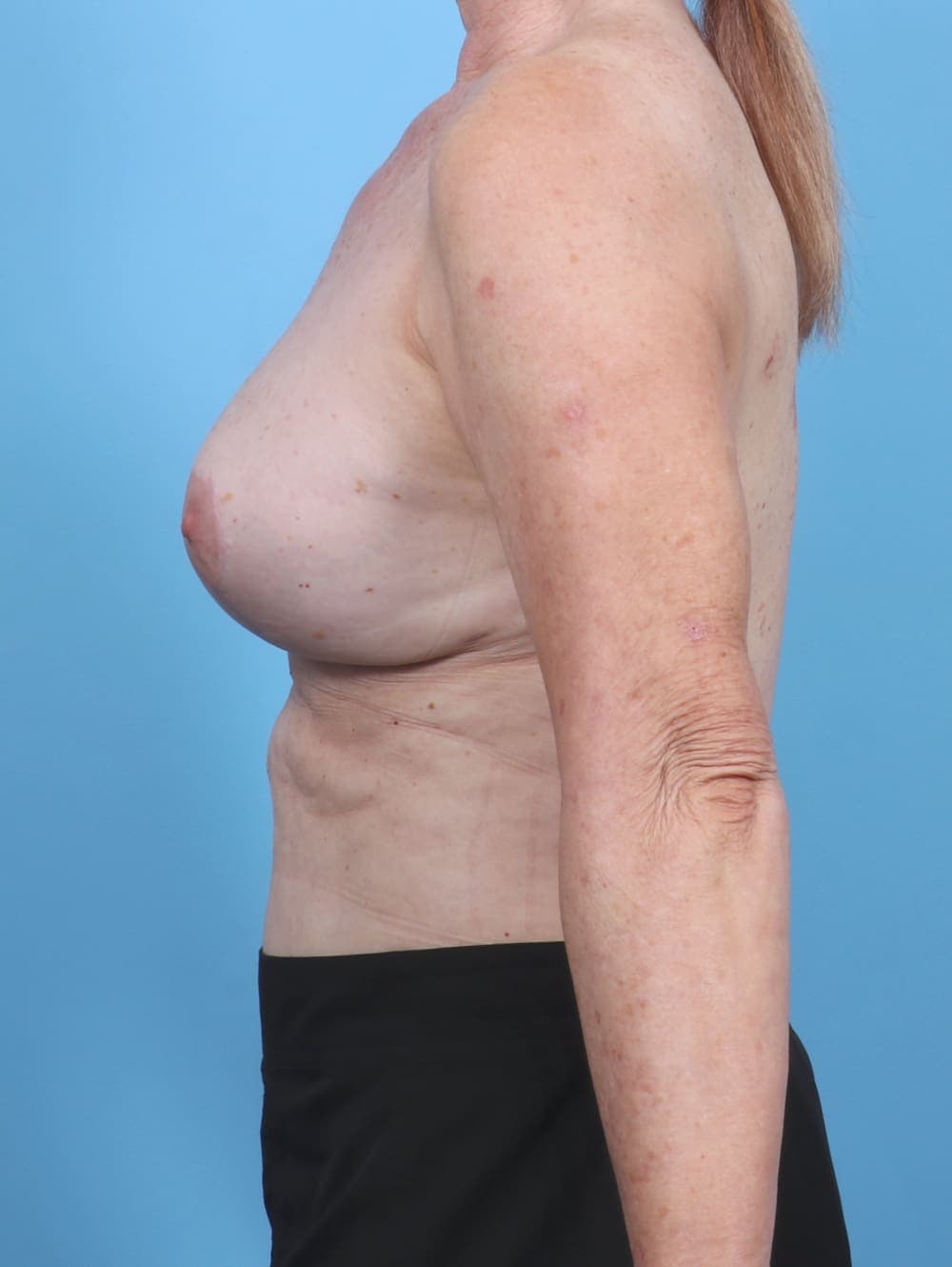 Breast Implant Revision case #5755 after, image 3