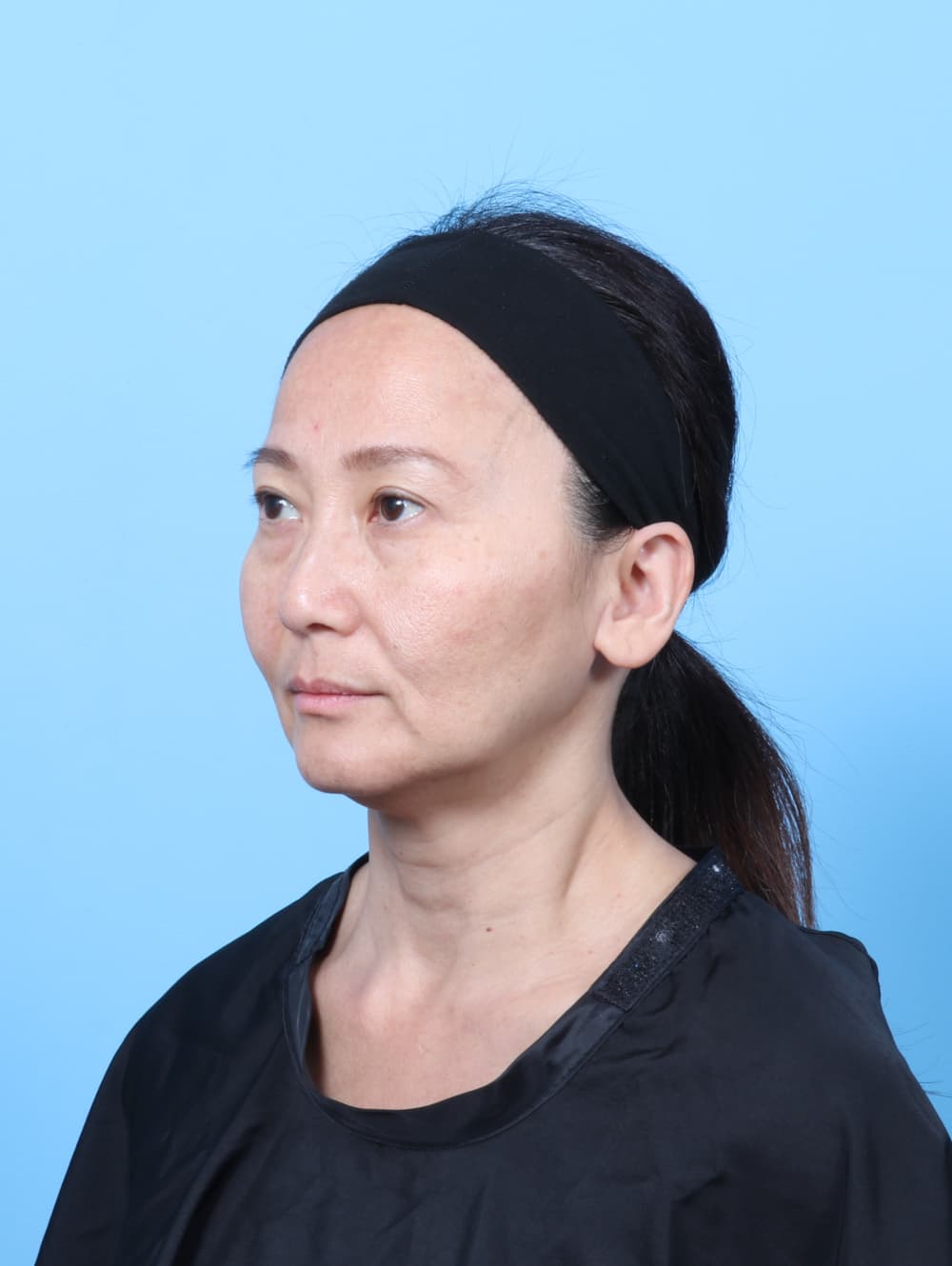 Eyelid Surgery case #7944 after, image 2