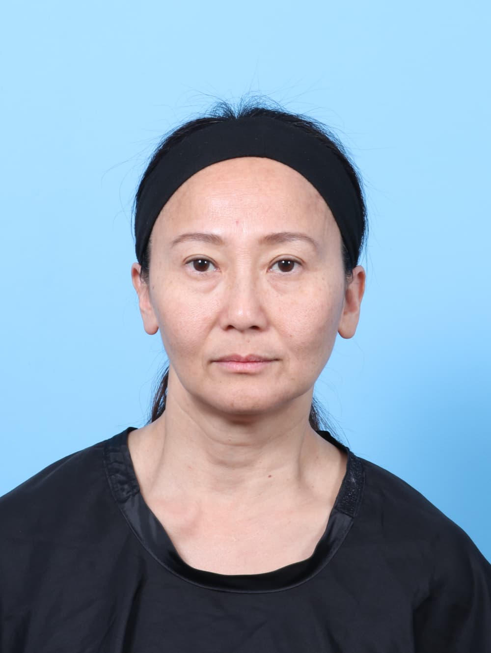 Eyelid Surgery case #7944 after