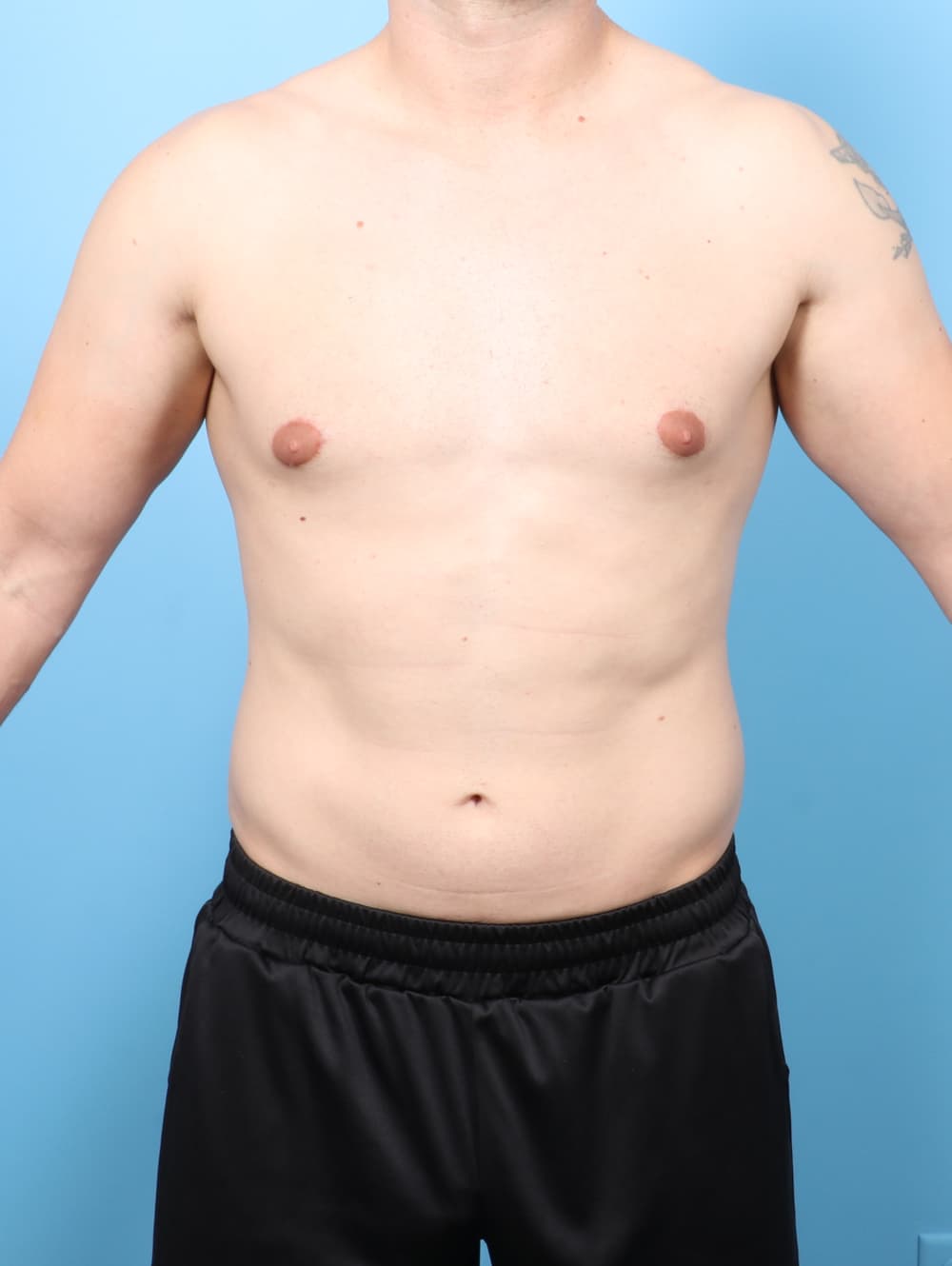 Male Breast Reduction case #8822 after, image 1