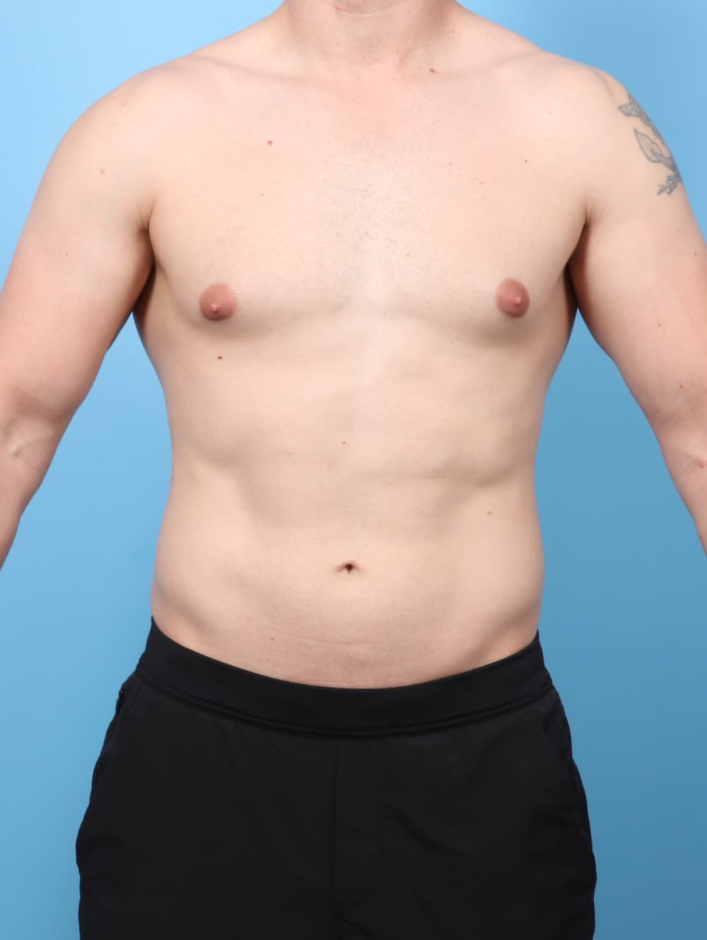 Male Breast Reduction case #8822 before, image 1