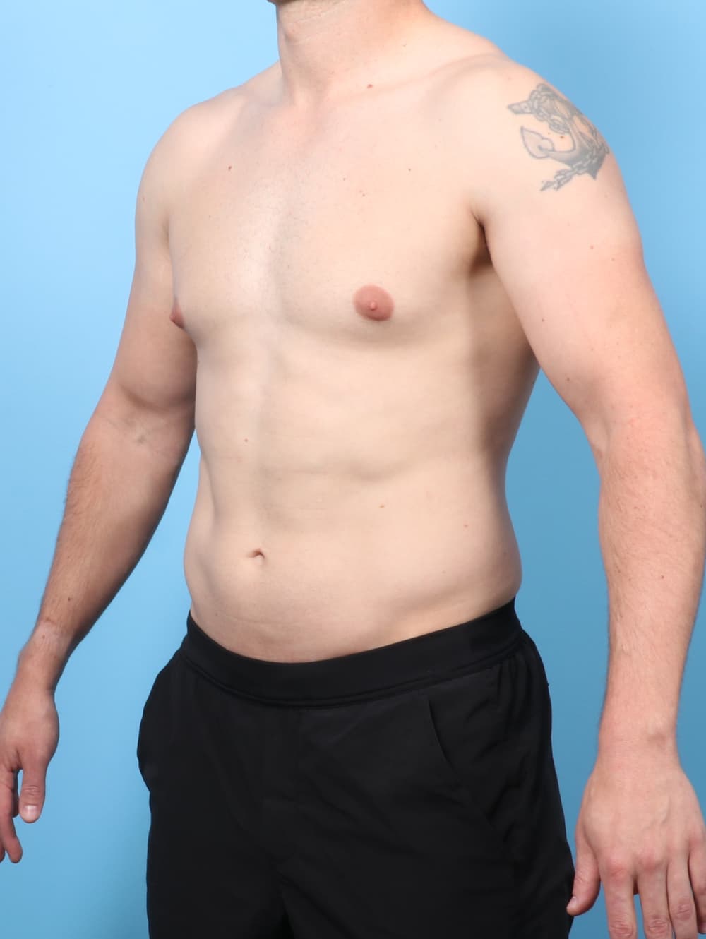 Male Breast Reduction case #8822 before, image 2