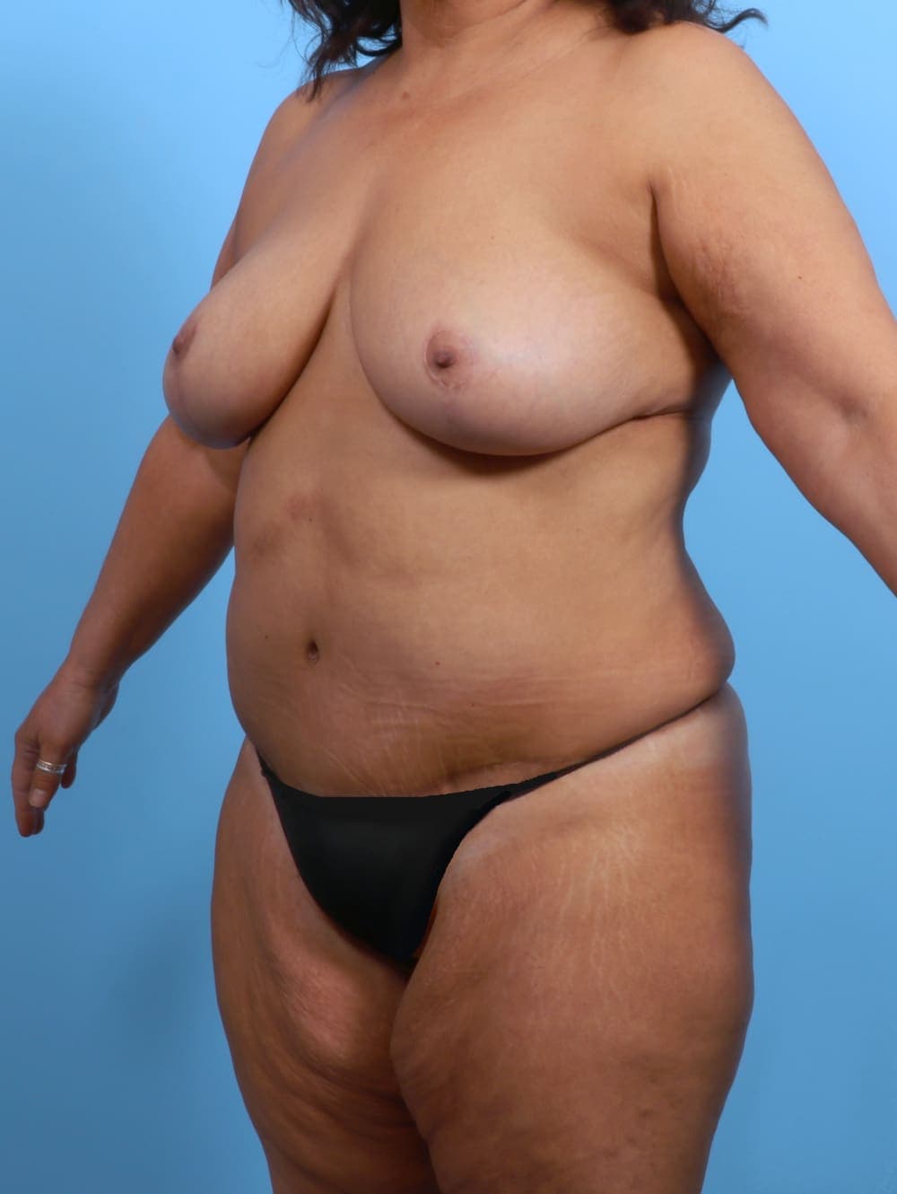 Breast Lift/Reduction case #3407 after, image 2