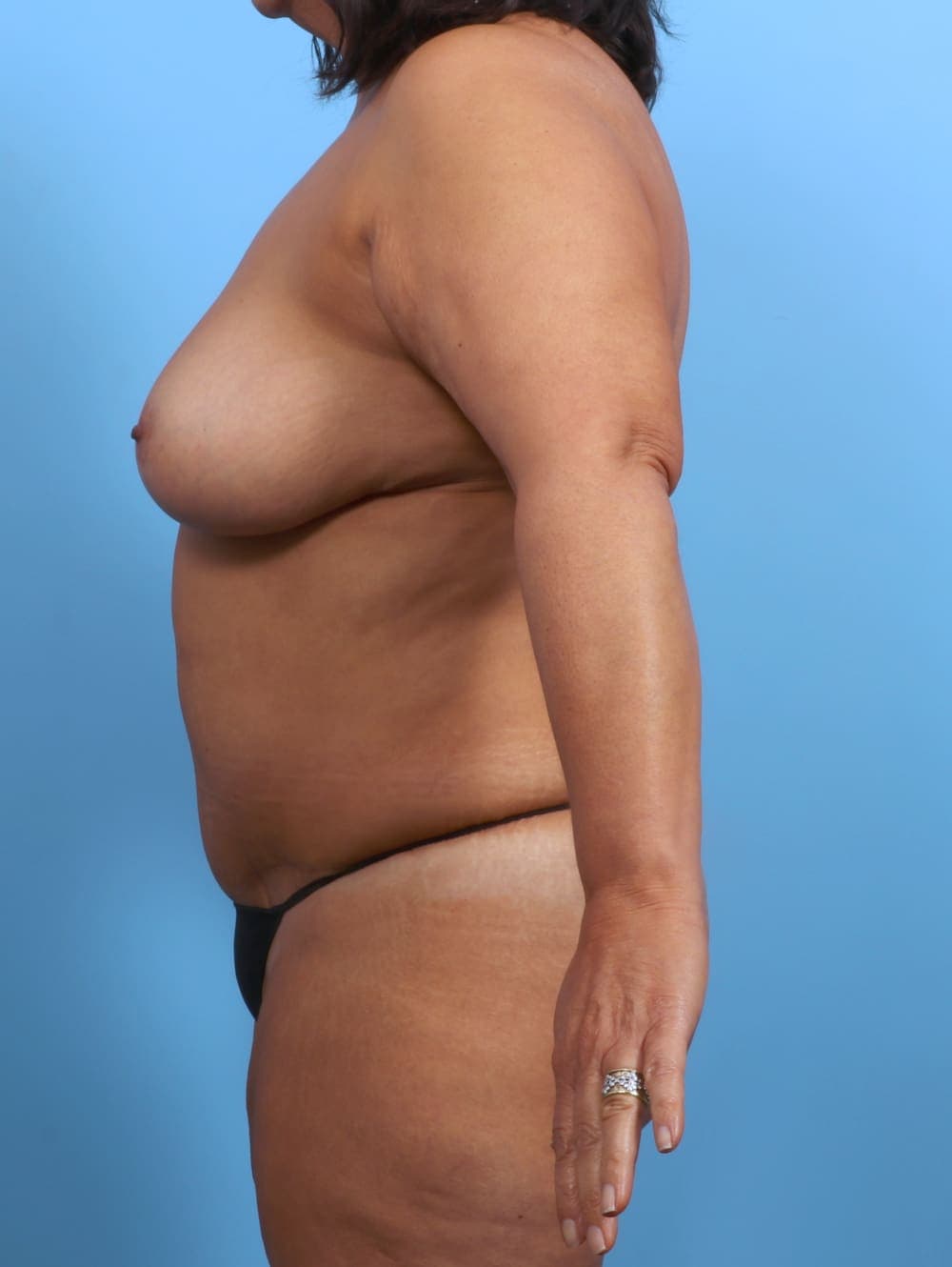 Breast Lift/Reduction case #3407 after, image 3
