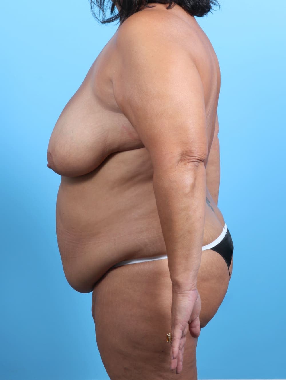 Breast Lift/Reduction case #3407 before, image 3