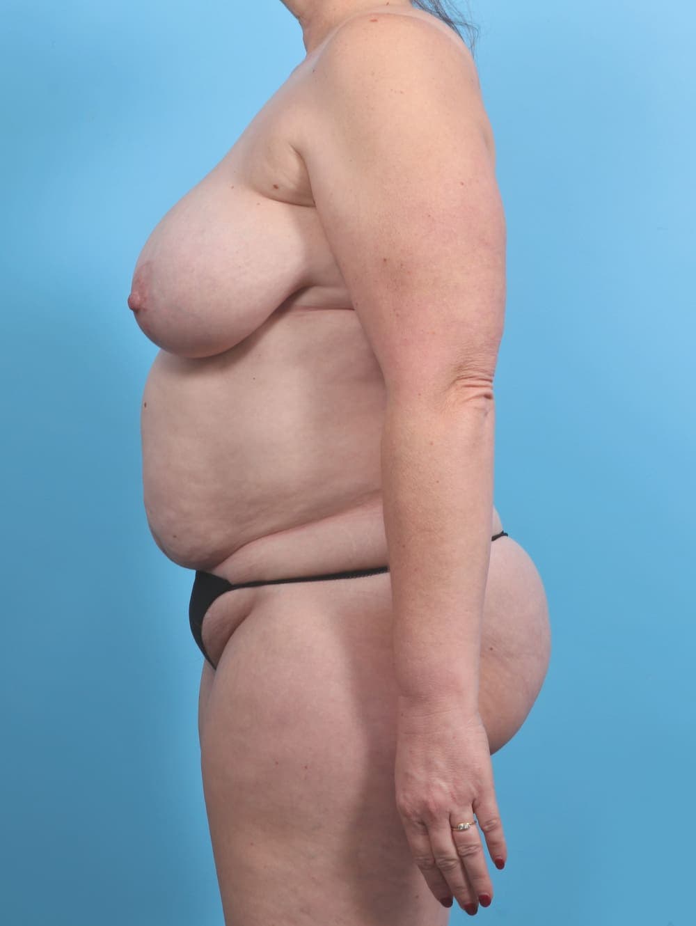 Mommy Makeover case #3941 before, image 4