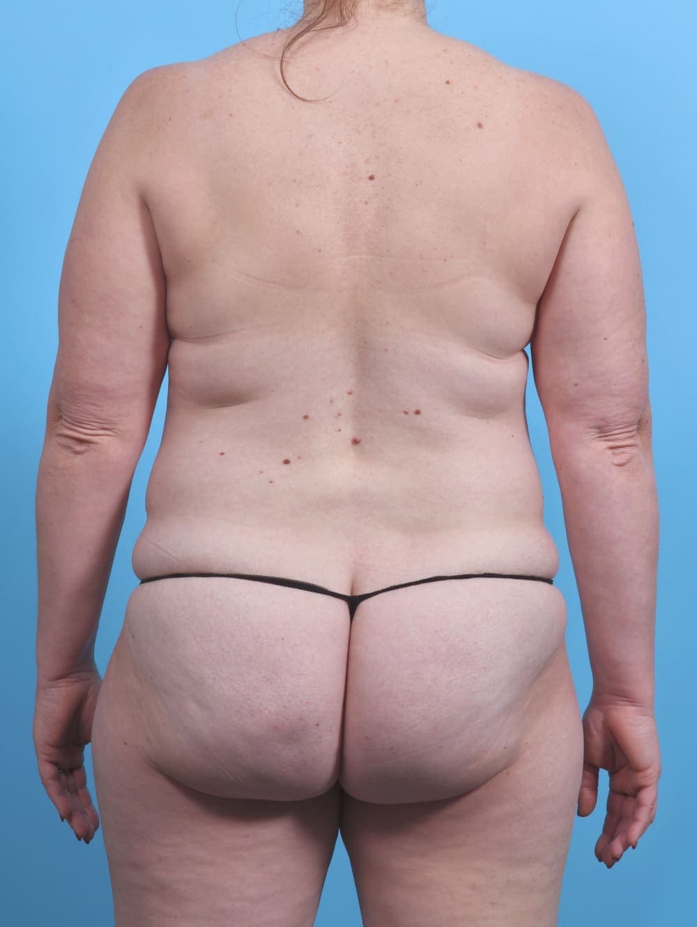Mommy Makeover case #3941 before, image 2