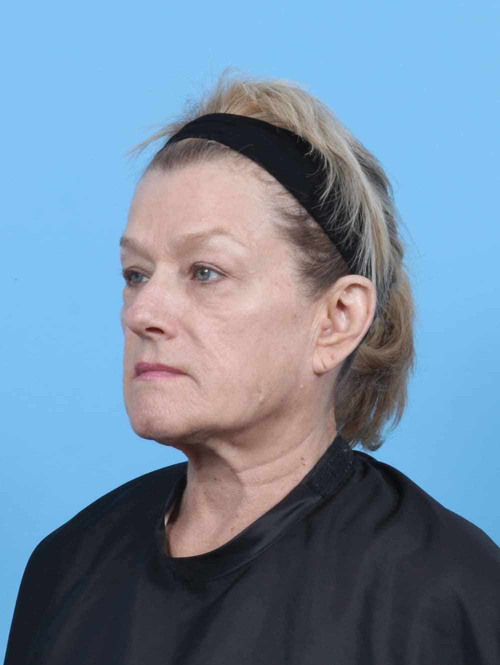 Eyelid Surgery case #6269 before, image 2