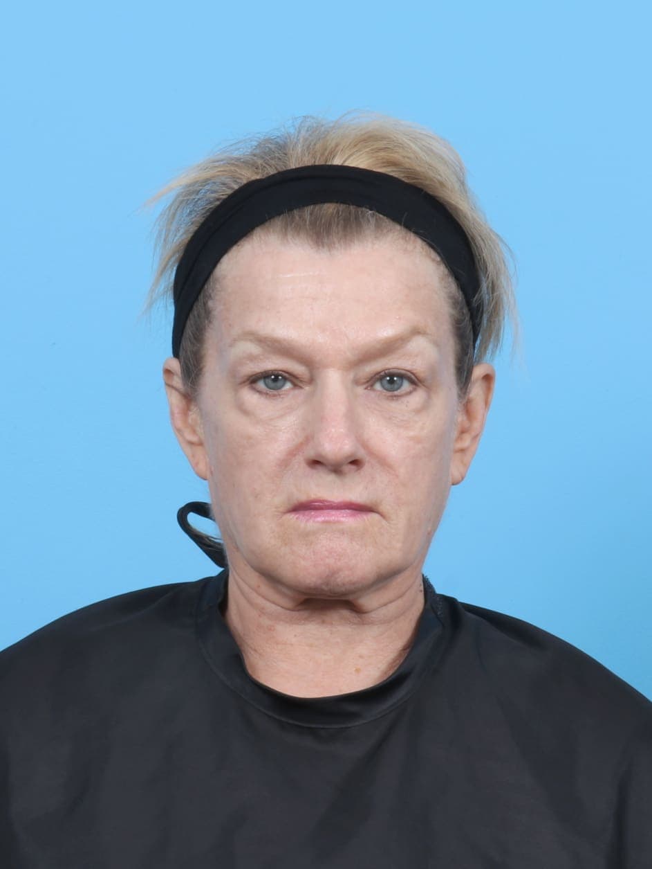 Eyelid Surgery case #6269 before, image 1