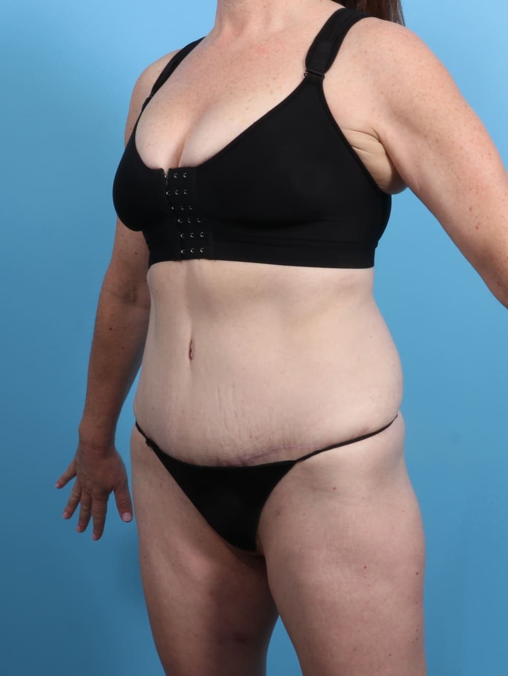 Tummy Tuck case #3415 after, image 2