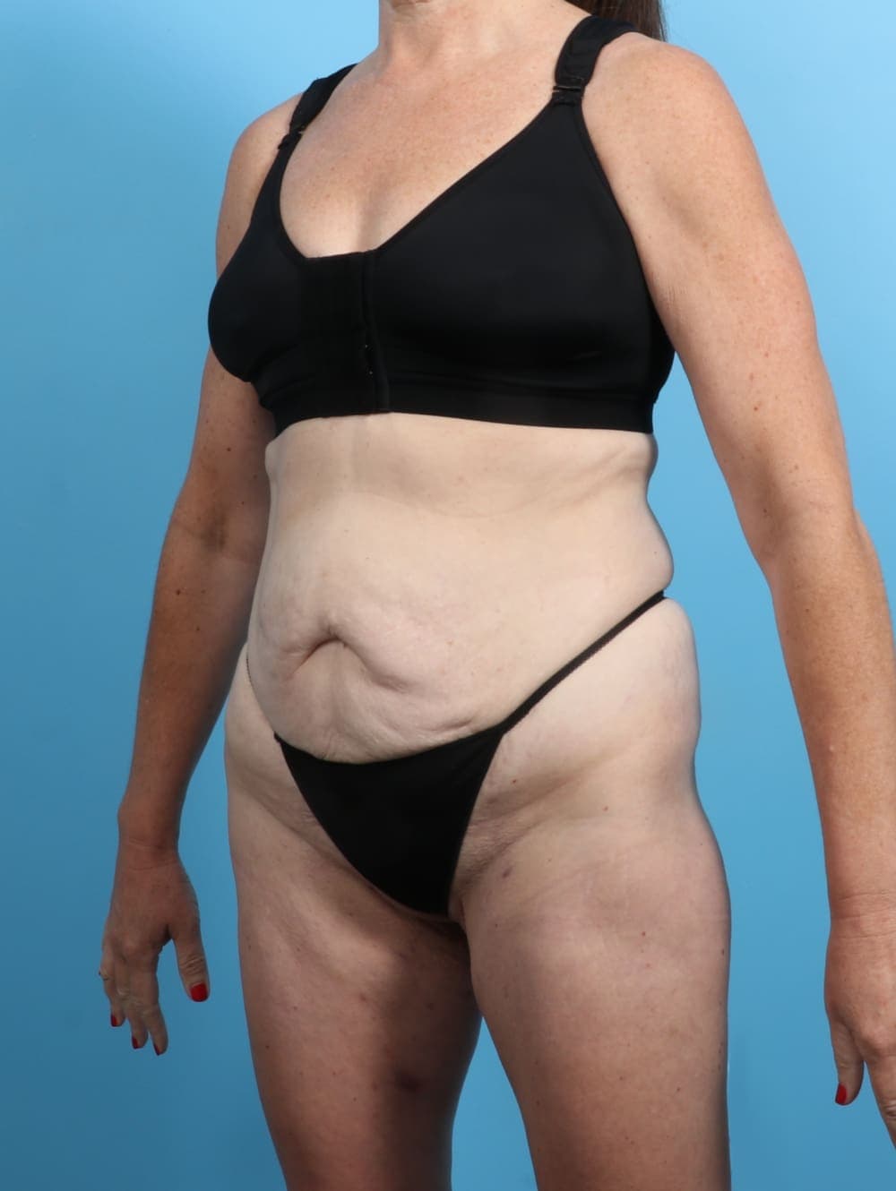 Tummy Tuck case #3415 before, image 2