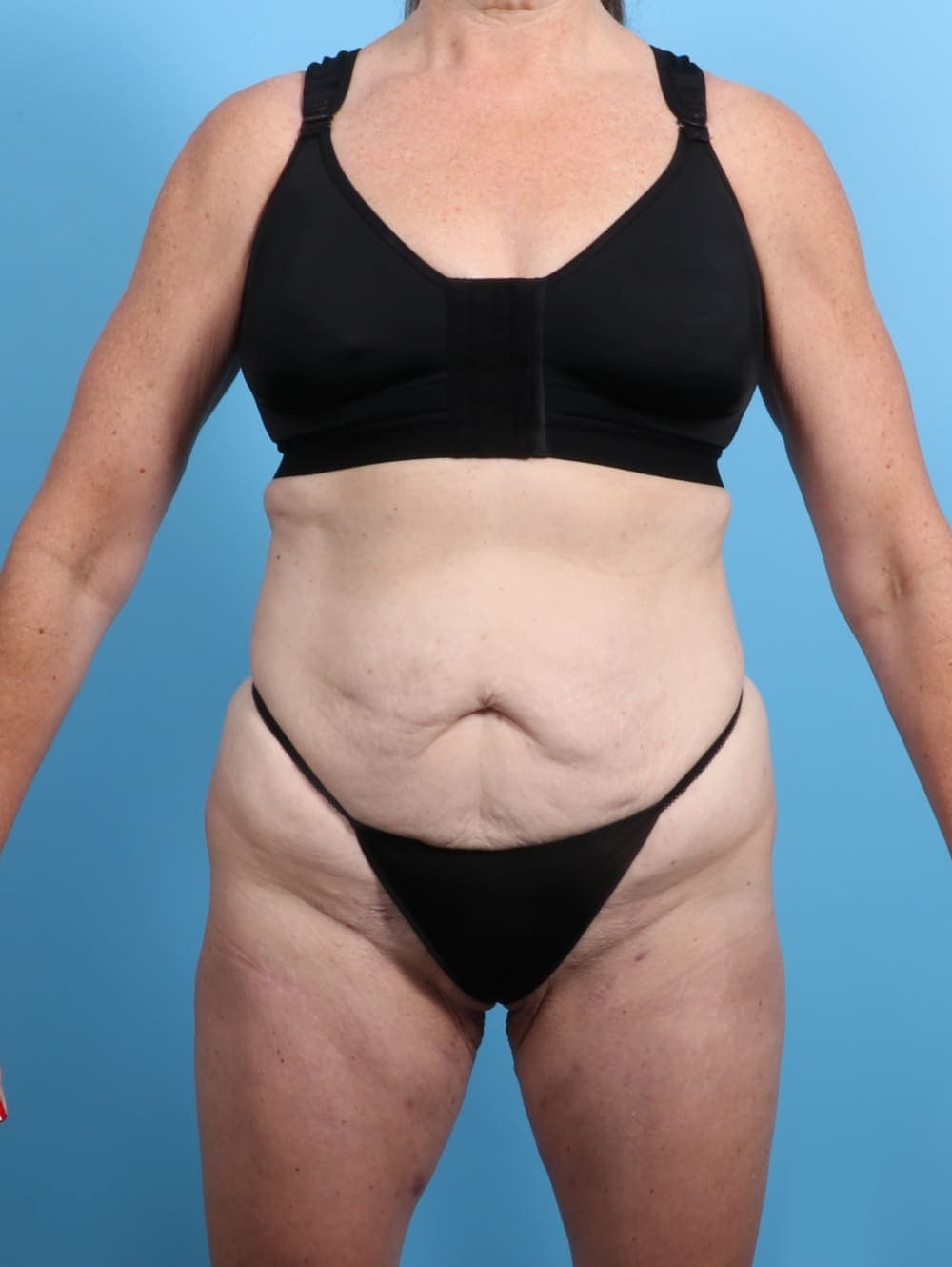 Tummy Tuck case #3415 before, image 1