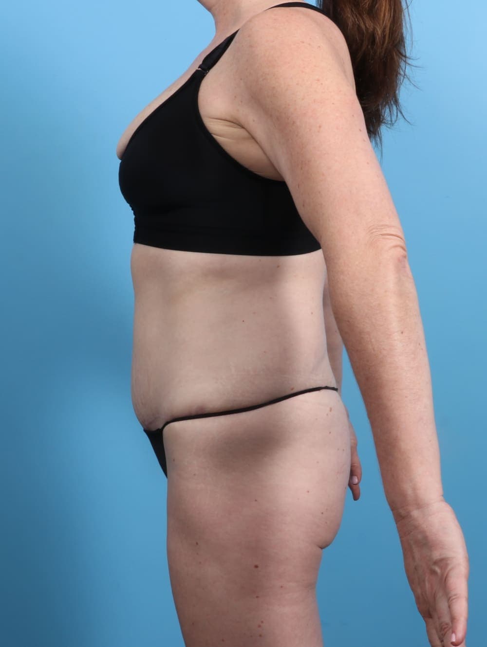 Tummy Tuck case #3415 after, image 3