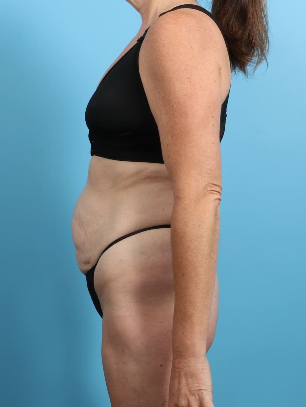 Tummy Tuck case #3415 before, image 3