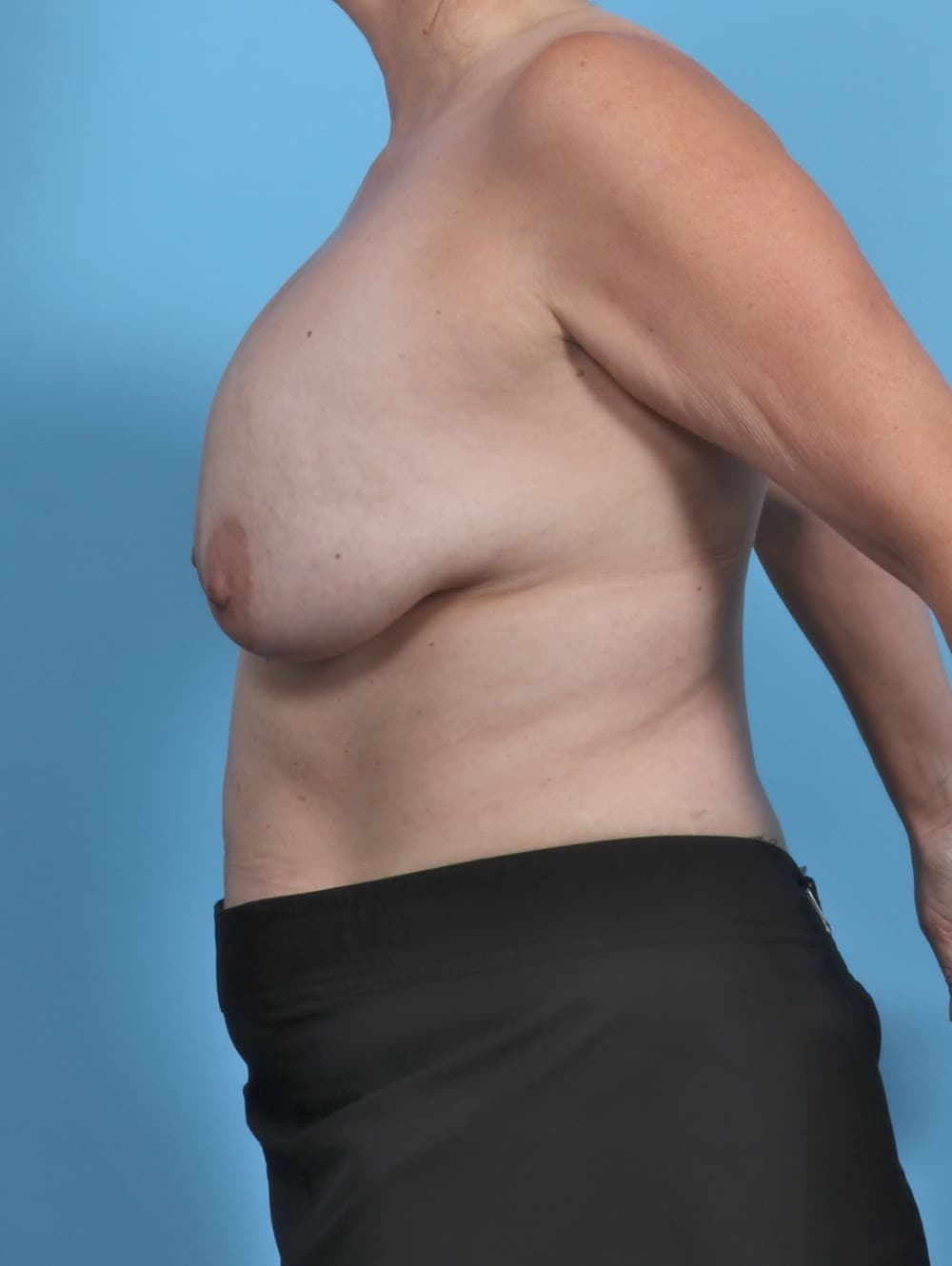 Breast Implant Revision case #5301 before, image 3
