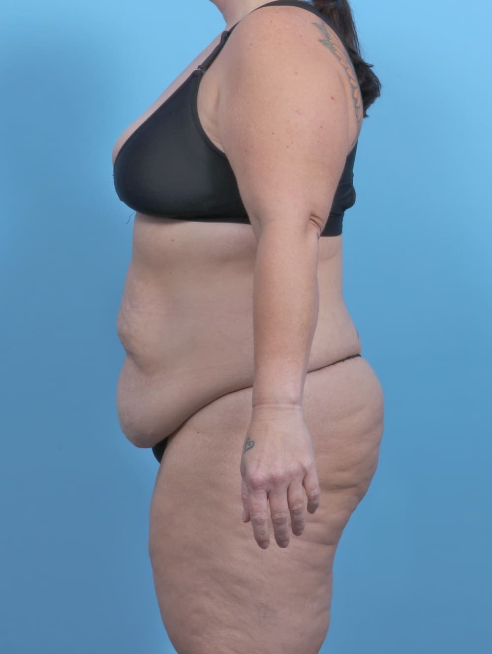 Tummy Tuck case #5789 before, image 3