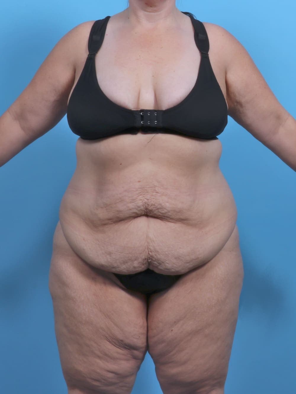 Tummy Tuck case #5789 before, image 1