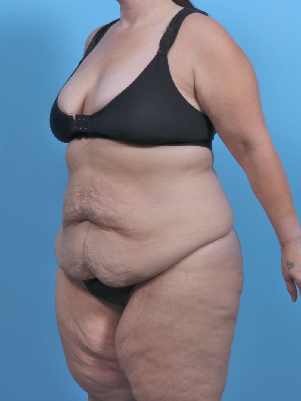 Tummy Tuck case #5789 before, image 2