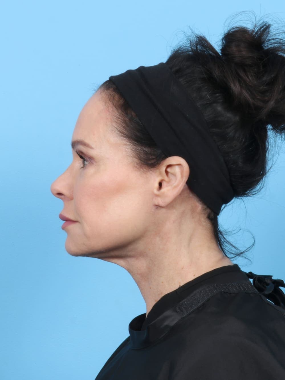 Facelift case #6261 after, image 3