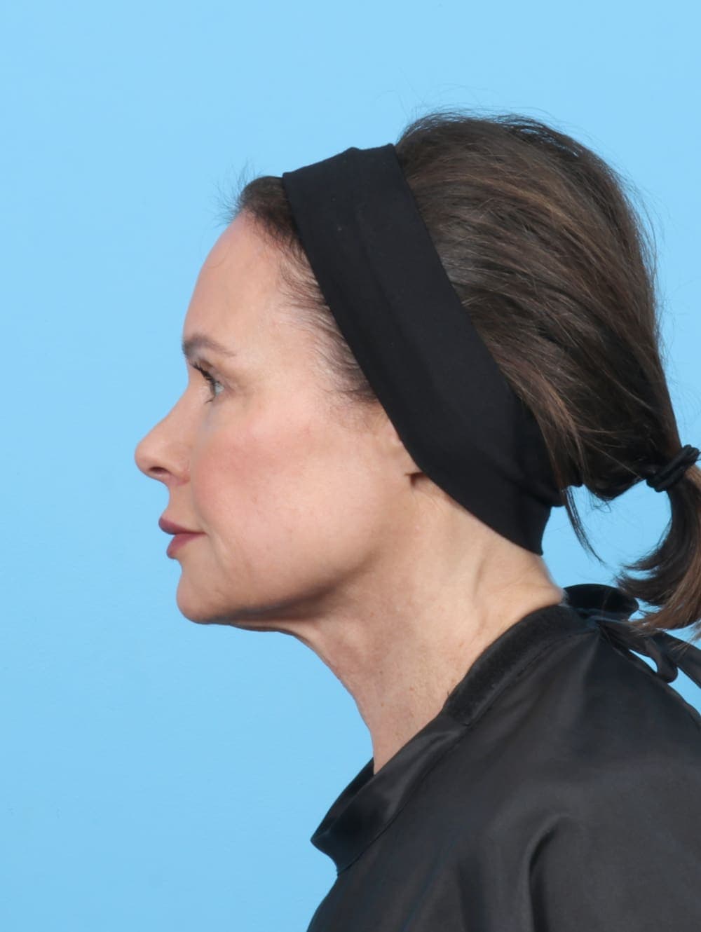Facelift case #6261 before, image 3