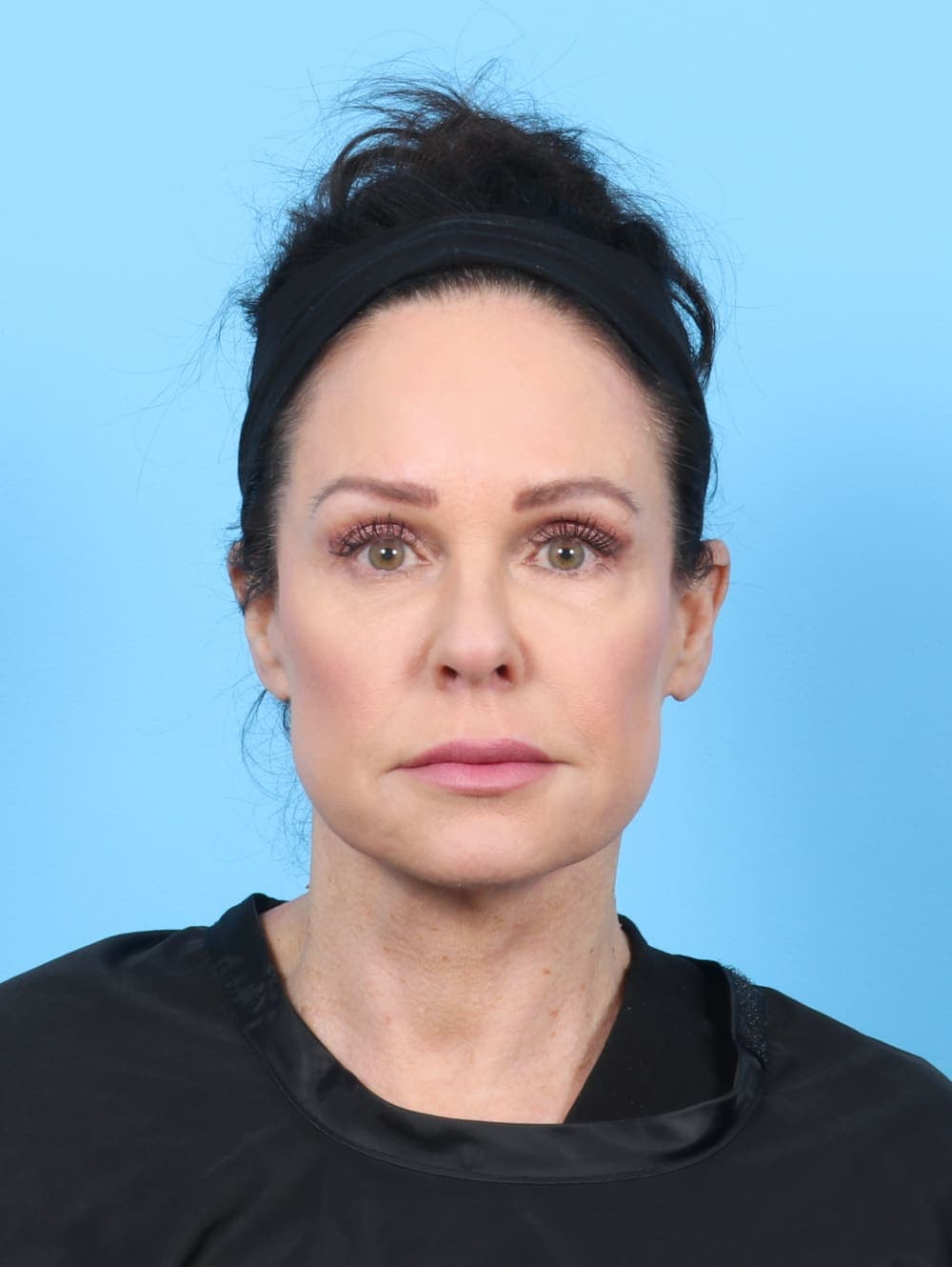 Facelift case #6261 after