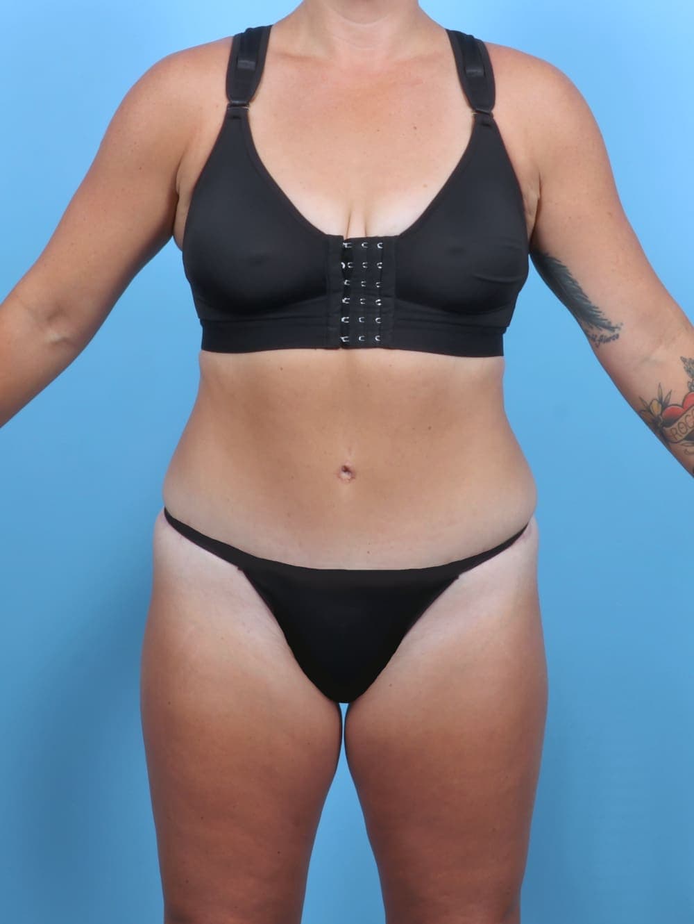 Tummy Tuck case #5813 after, image 1
