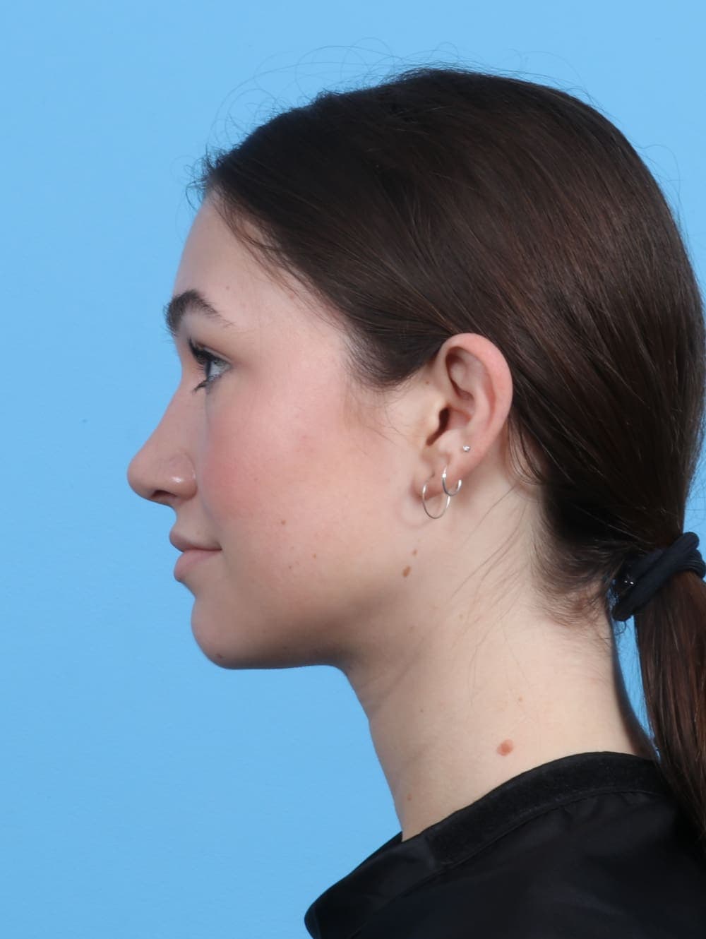 Rhinoplasty case #3311 after