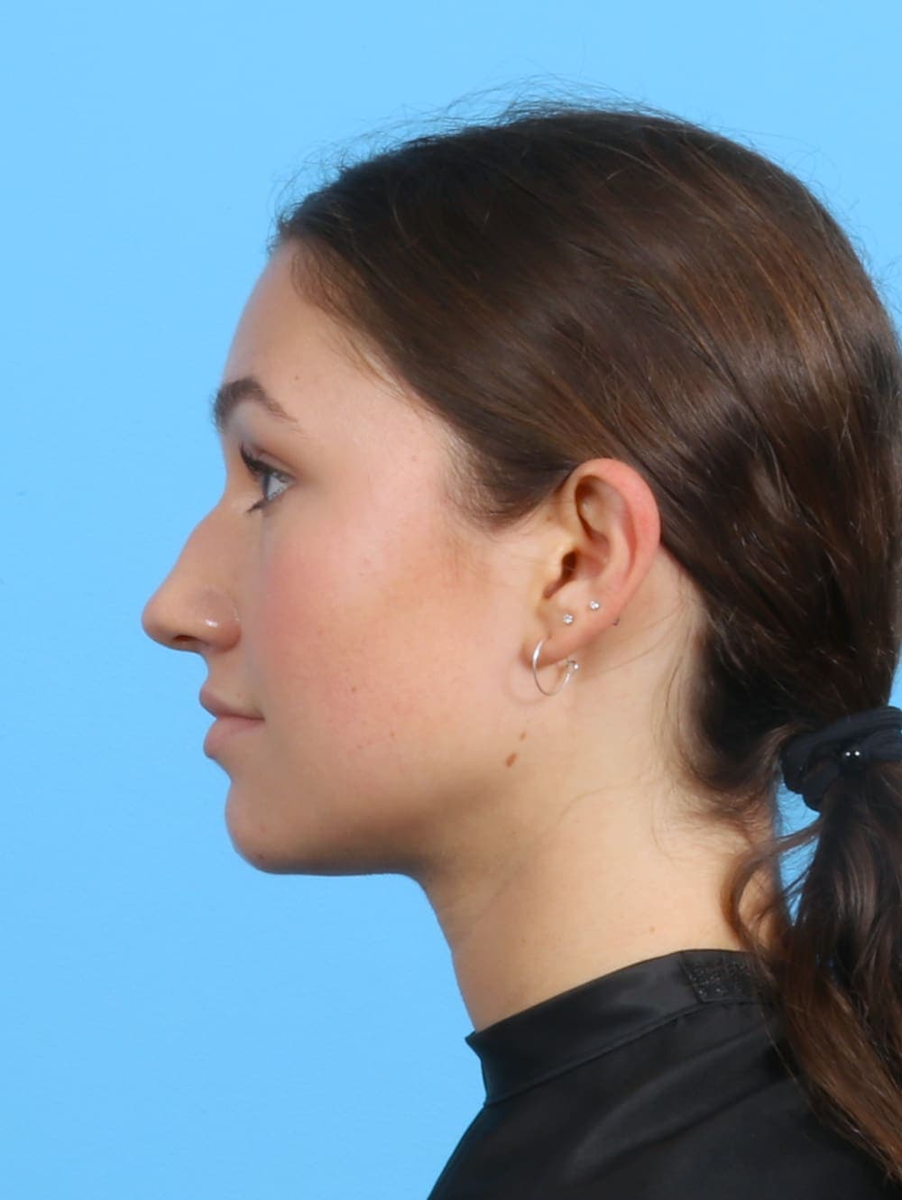 Rhinoplasty case #3311 before