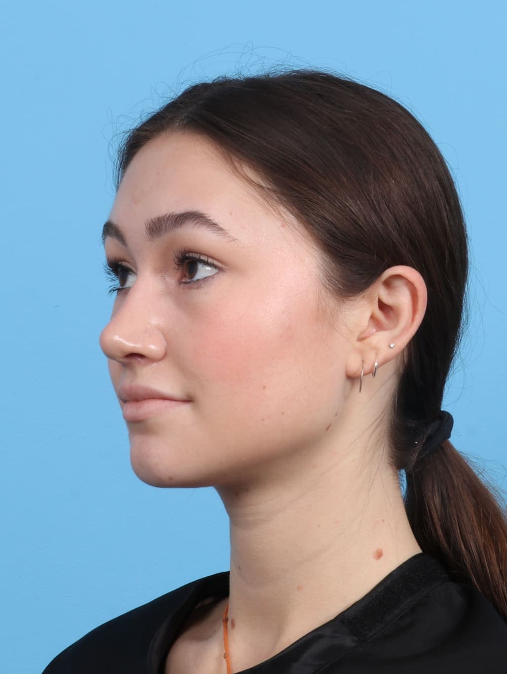 Rhinoplasty case #3311 after, image 3