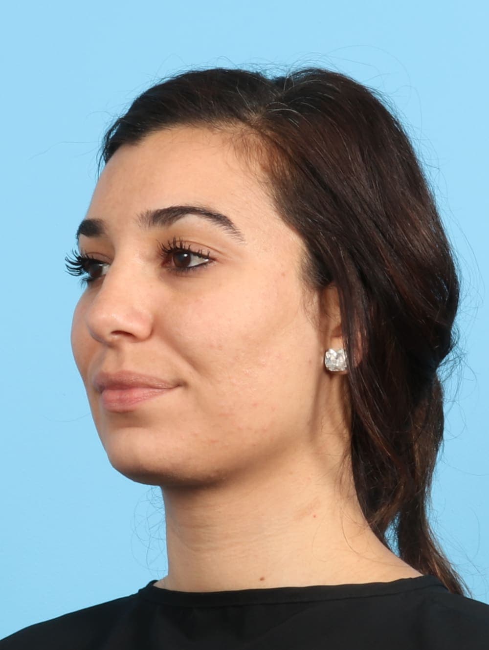 Rhinoplasty case #2354 after, image 3