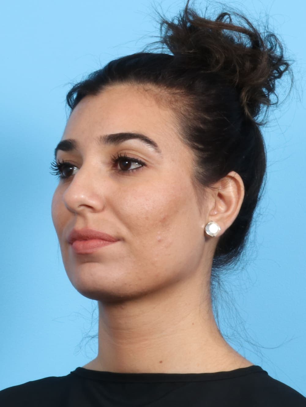 Rhinoplasty case #2354 before, image 3