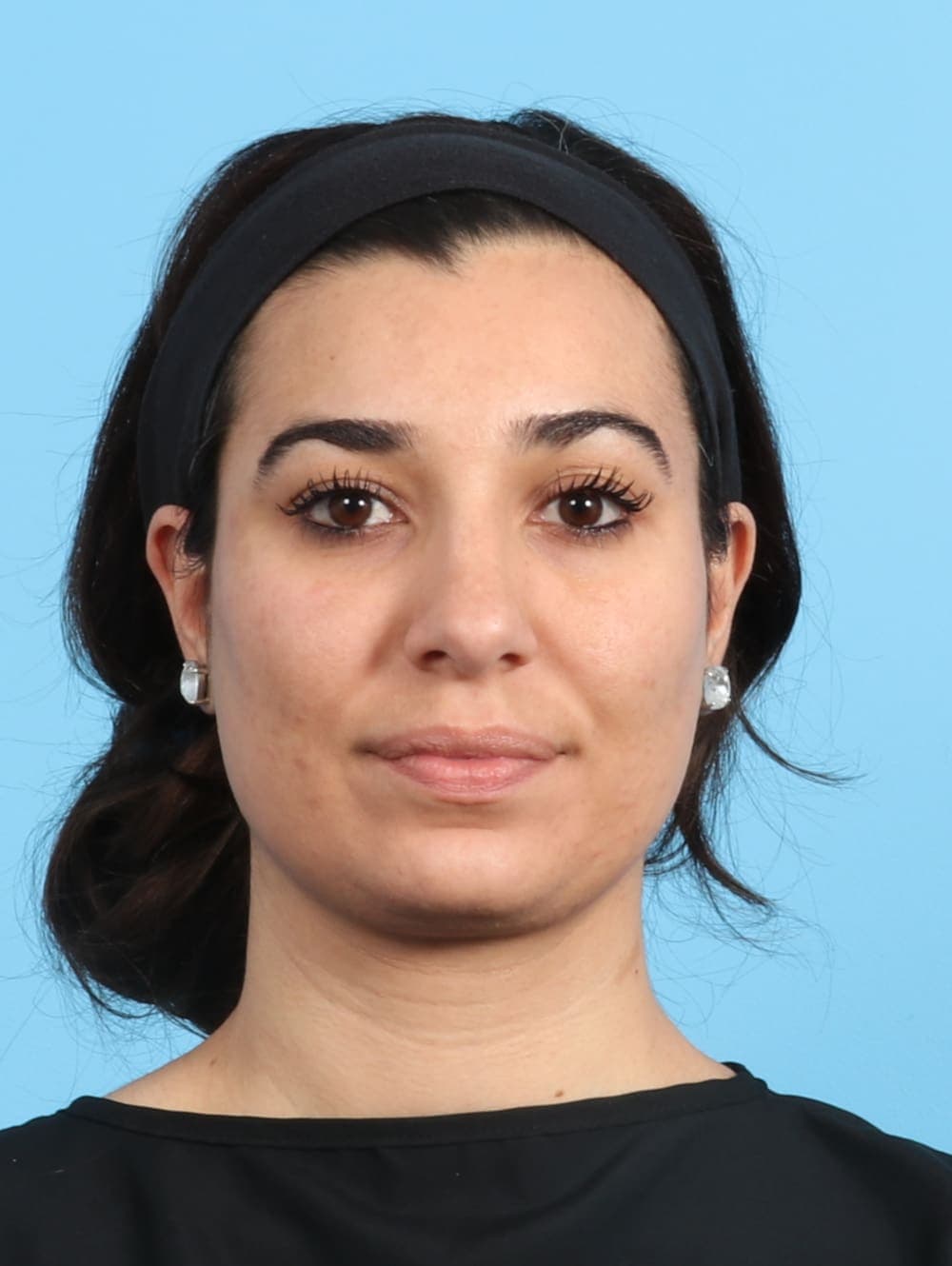 Rhinoplasty case #2354 after, image 2