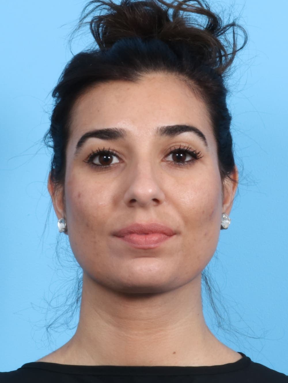 Rhinoplasty case #2354 before, image 2