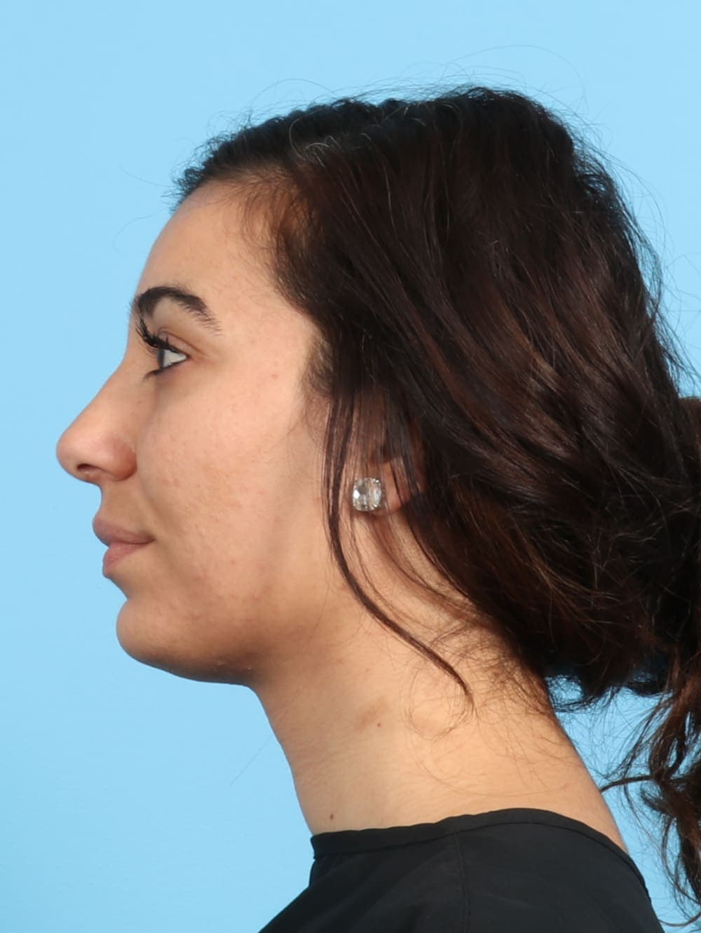 Rhinoplasty case #2354 after, image 1