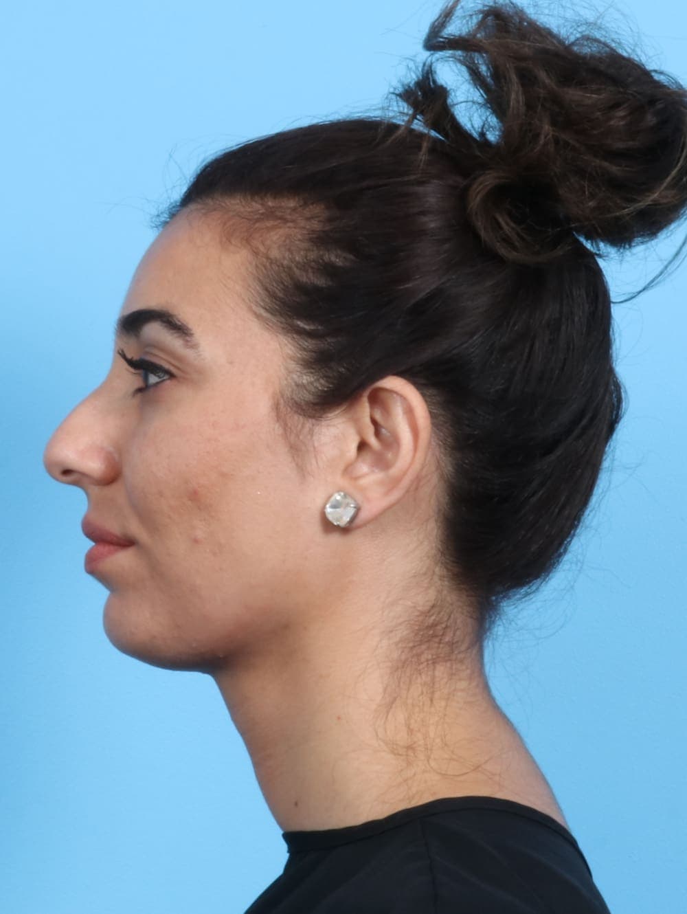 Rhinoplasty case #2354 before, image 1