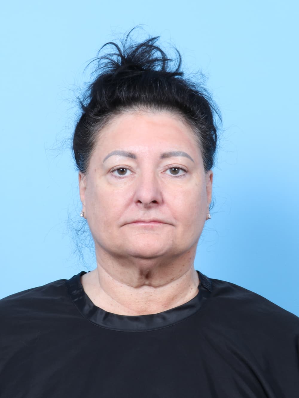 Eyelid Surgery case #7453 after