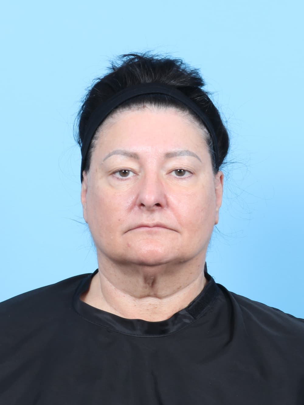 Eyelid Surgery case #7453 before