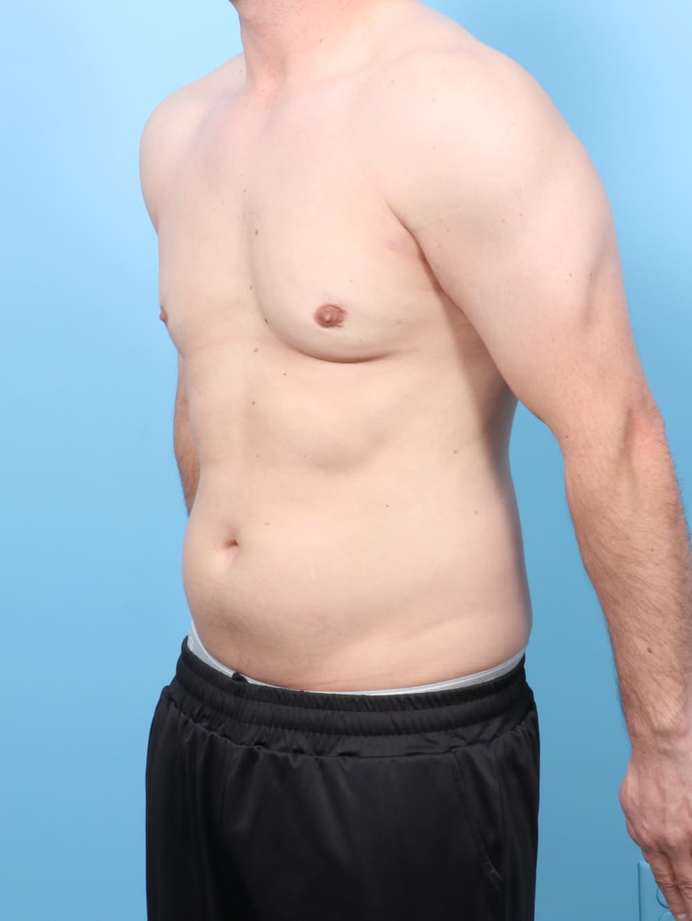 Male Breast Reduction case #7527 after, image 2