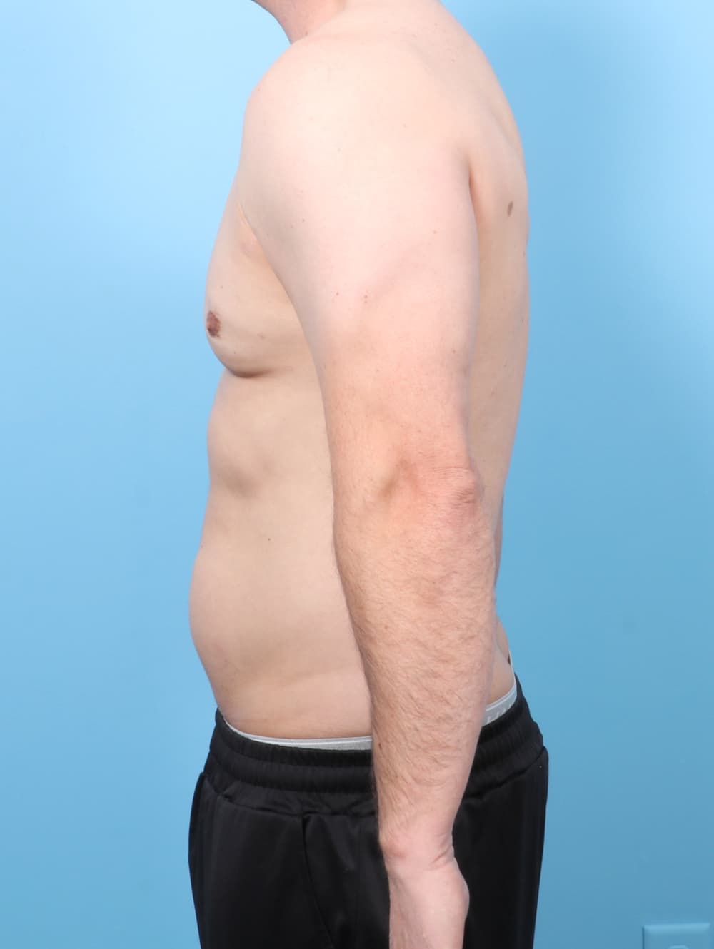 Male Breast Reduction case #7527 after, image 3