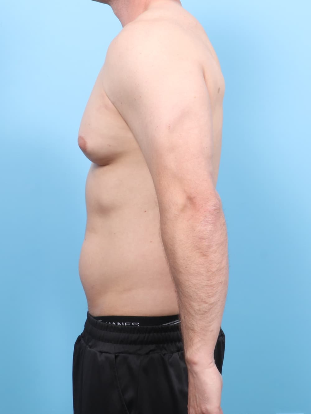 Male Breast Reduction case #7527 before, image 3