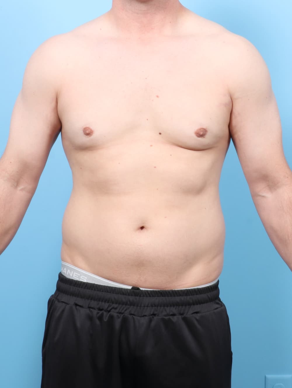 Male Breast Reduction case #7527 after, image 1