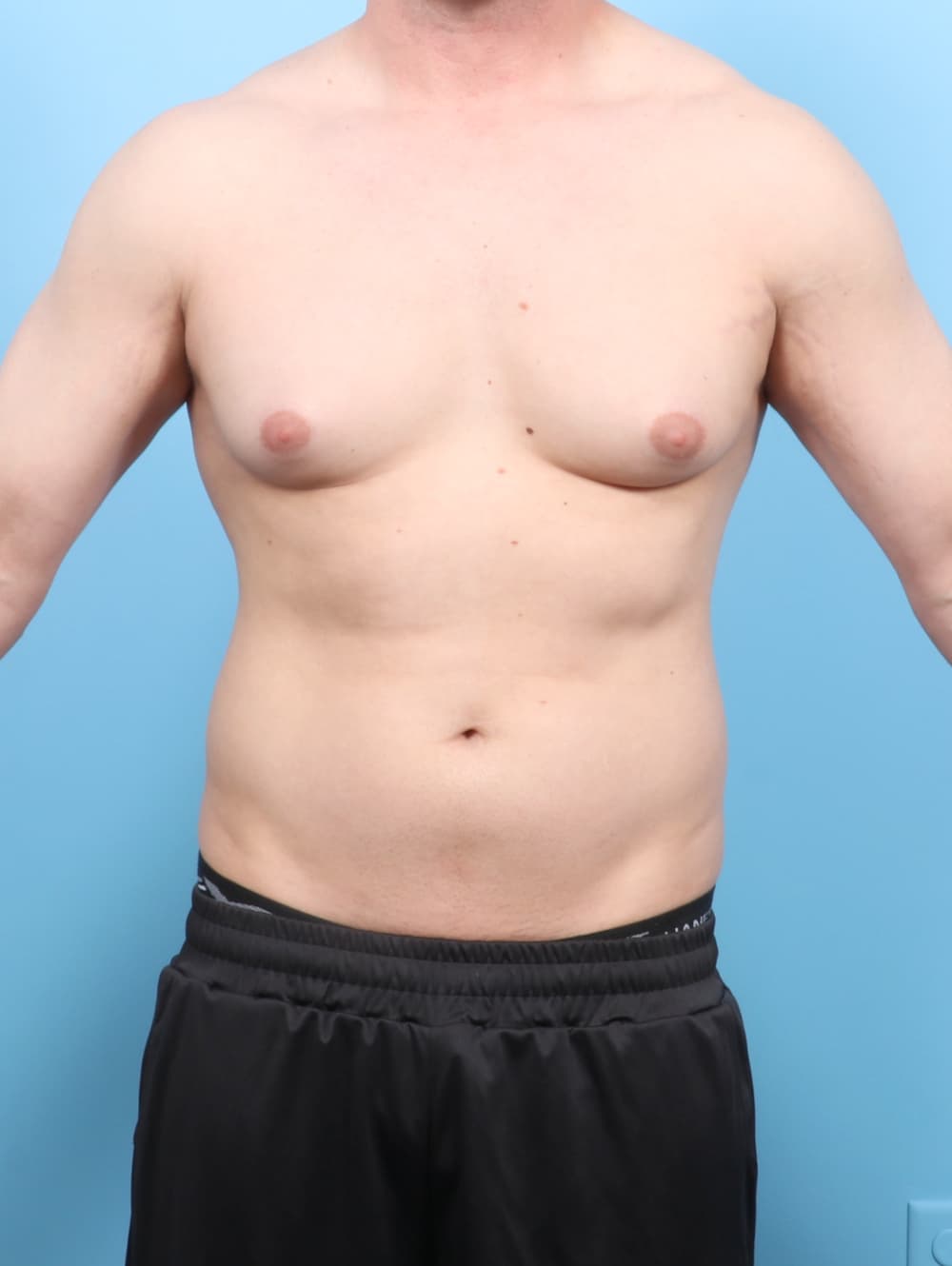 Male Breast Reduction case #7527 before, image 1