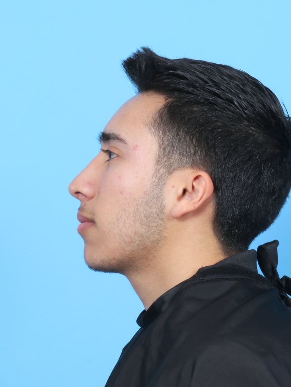 Rhinoplasty case #6229 after