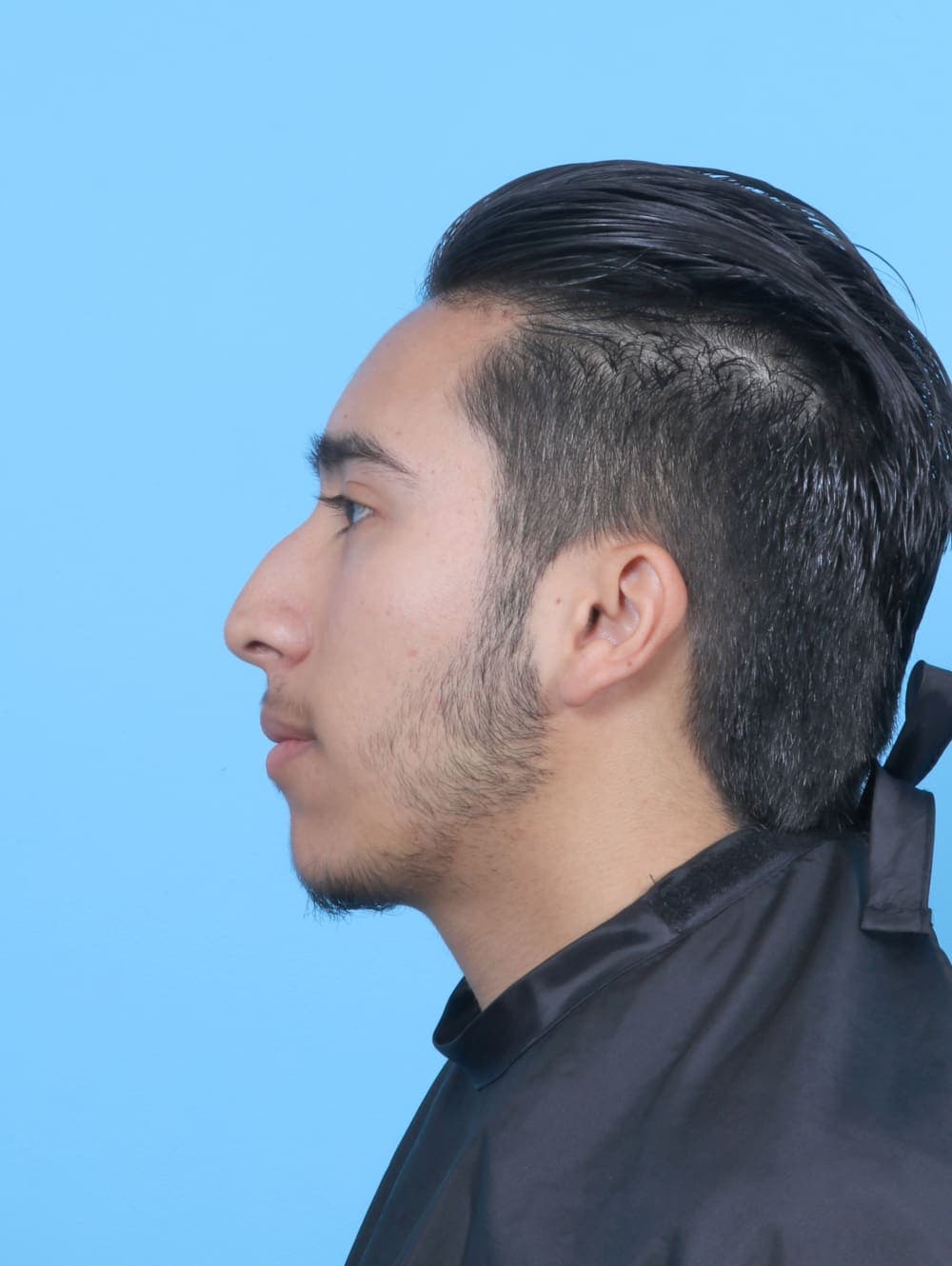 Rhinoplasty case #6229 before