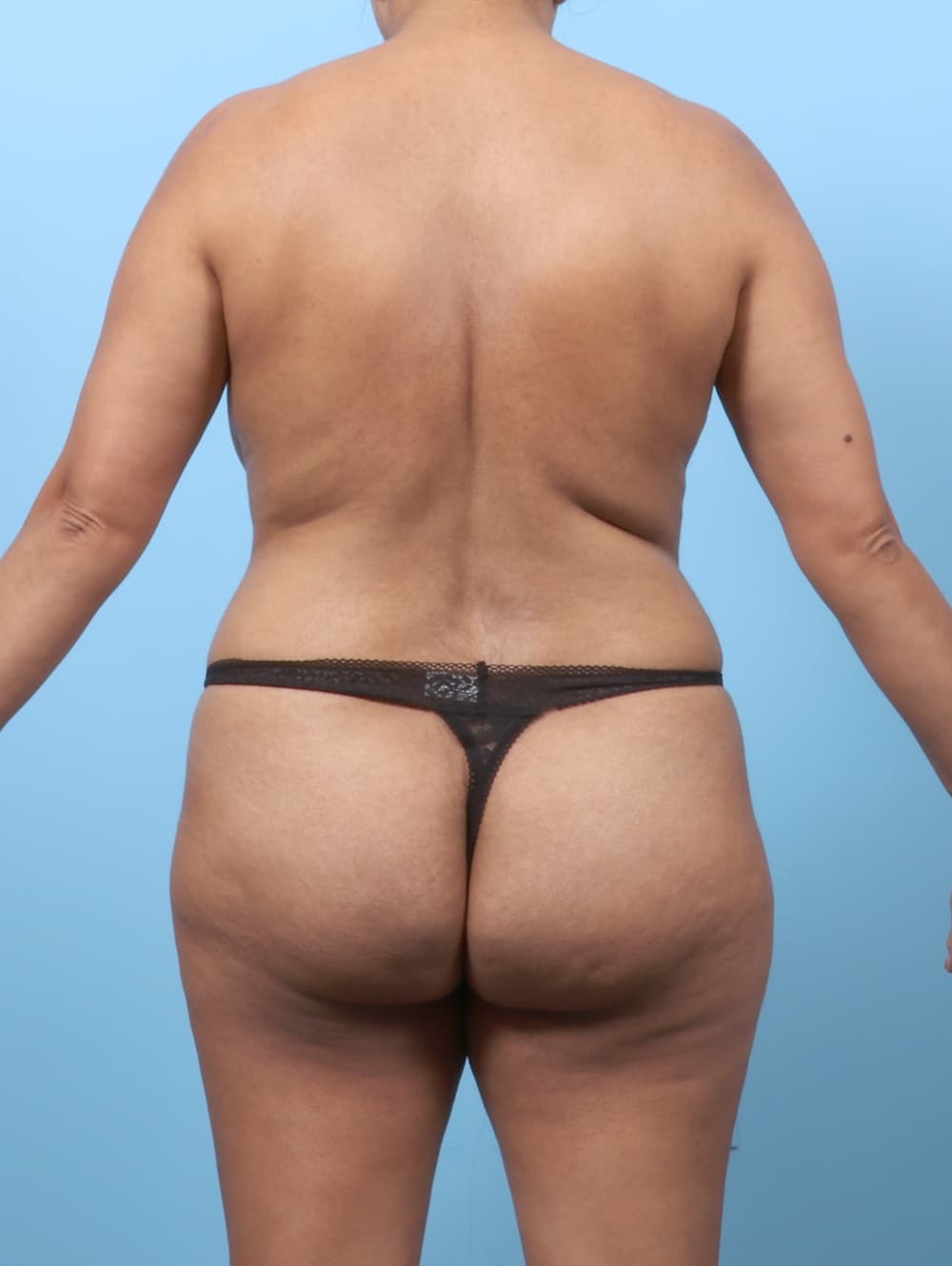Liposuction case #8978 before, image 4